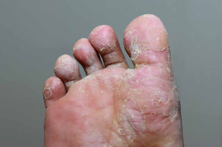 Athletes-Foot_Fungal-Infections_Skincare